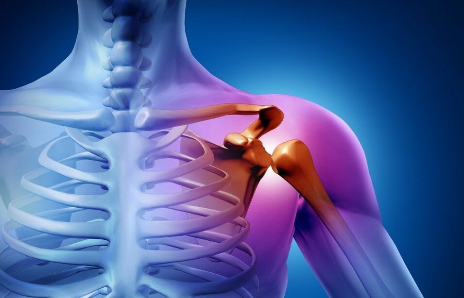 Травма плечевого сустава из-за остеоартрита